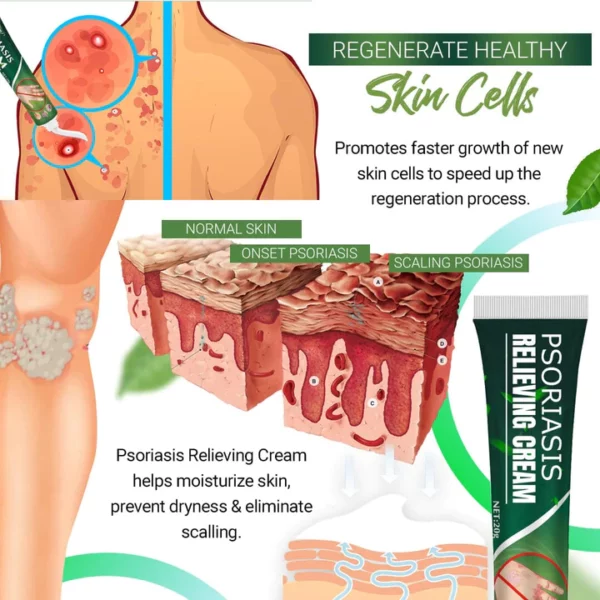 Psoriasis Relieving Cream