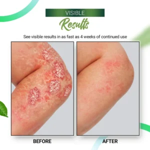 Psoriasis Relieving Cream