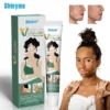 Shinyme Vitiligo Skin Repair Cream