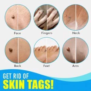 Skin Tag Remover Kit