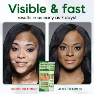 SpotCare™ Vitiligo Therapeutic Cream