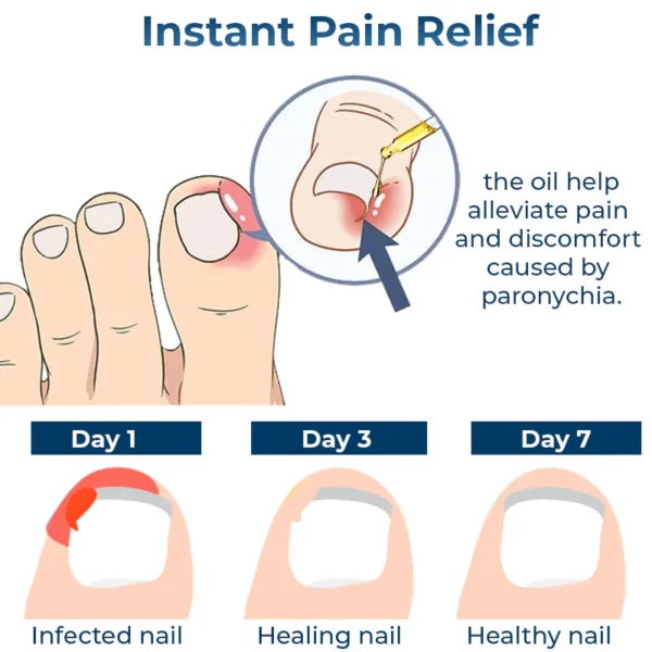 ToenailPlus™ German Anti Paronychia Relief Oil