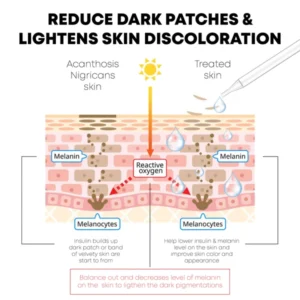 ATTDX AcanthosisNigricans Treatment Oil