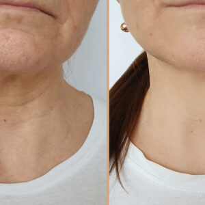 ATTDX PerfectNeck CollagenFirming LaceMask