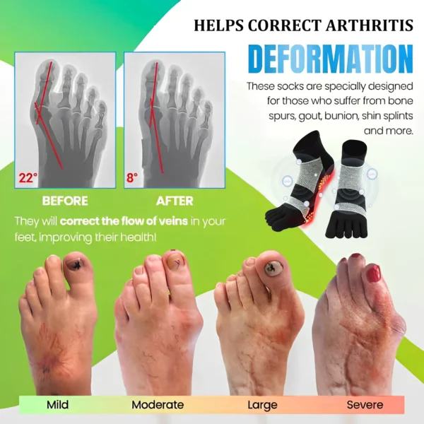 Anti Arthritis Detox Tourmaline Acupressure Sock