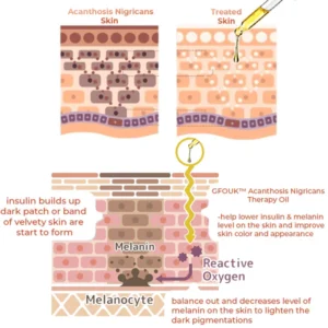 GFOUK™ Acanthosis Nigricans Therapie-Öl