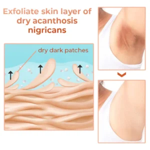 GFOUK™ Acanthosis Nigricans Therapie-Öl