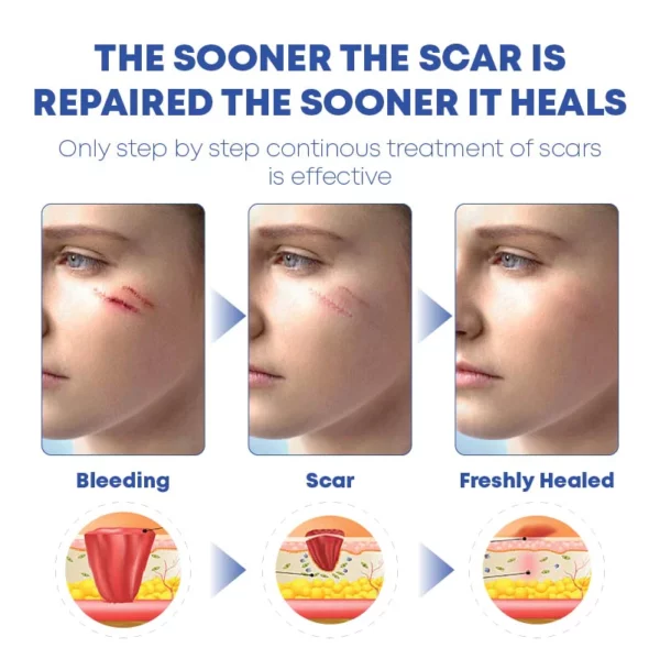 MEDVMA NonSurgical ScarRemoval SiliconTape