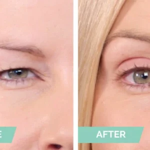 One® Natural Invisible Eyelid