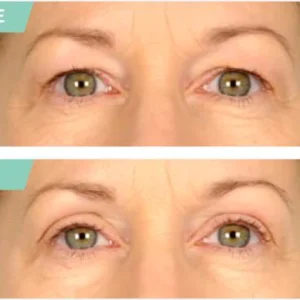 One® Natural Invisible Eyelid