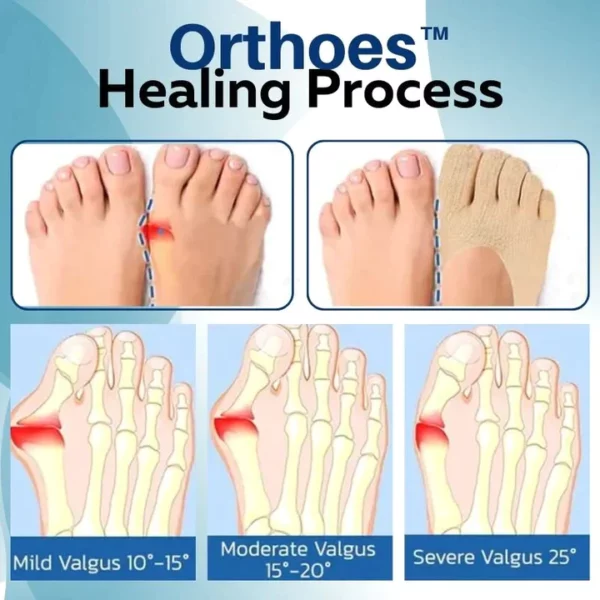 Orthoes™ Bunion-Relief Socks - Image 4