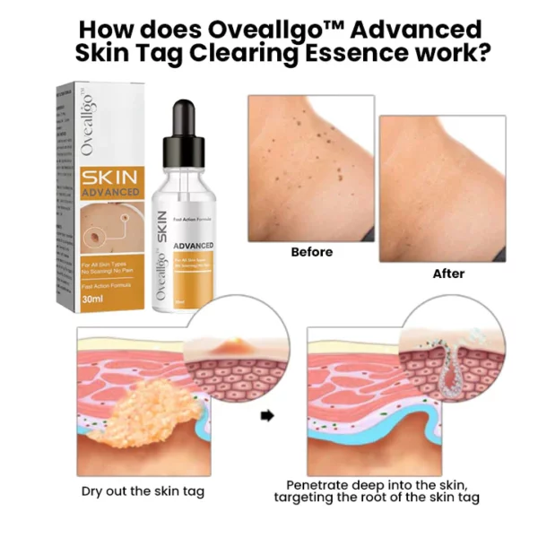 Oveallgo™ Advanced Skin Tag Clearing Essence - Image 2