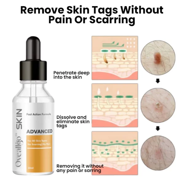 Oveallgo™ Advanced Skin Tag Clearing Essence - Image 3