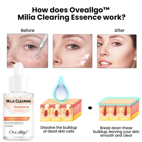 Oveallgo™ Milia Clearing Essence - Image 2