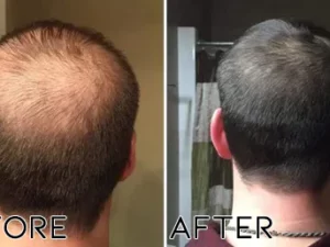 Oveallgo™ Minoxidil Hair Regrowth Treatment