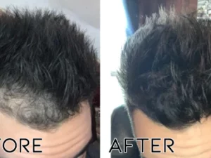 Oveallgo™ Minoxidil Hair Regrowth Treatment