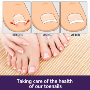 PARONYCHIA REPAIR NAIL ELASTIC CORRECTIVE PATCH