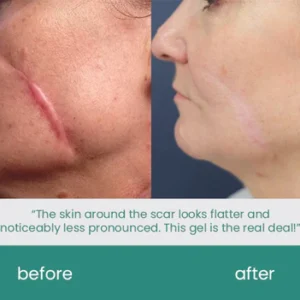 ScarXpert™ Advanced Scar Removal Gel