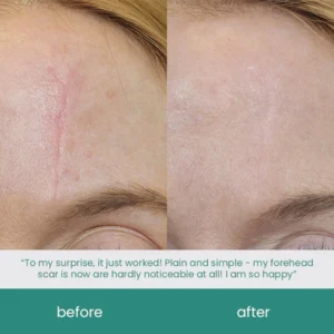 ScarXpert™ Advanced Scar Removal Gel