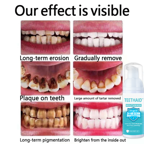 TEETHAID™ MOUTHWASH and CALCULUS REMOVAL