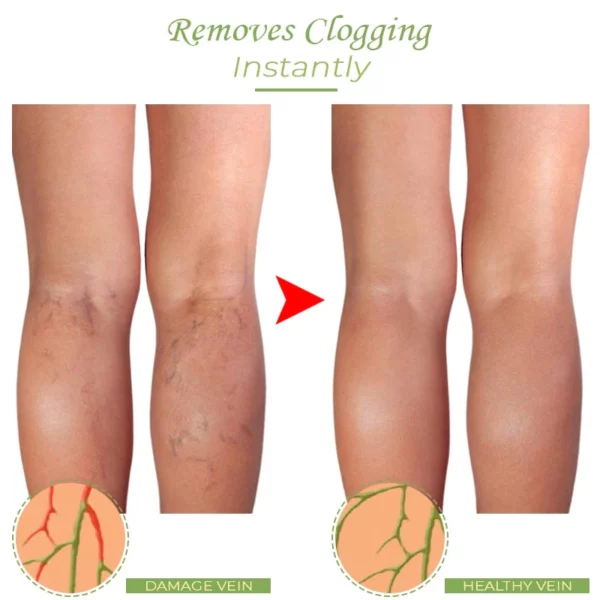 VeinCare VaricoseVein Healing Cream - Image 4