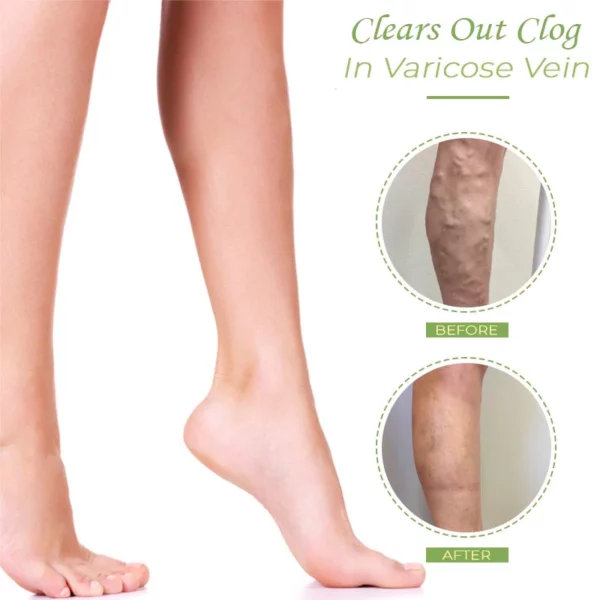 VeinCare VaricoseVein Healing Cream - Image 6