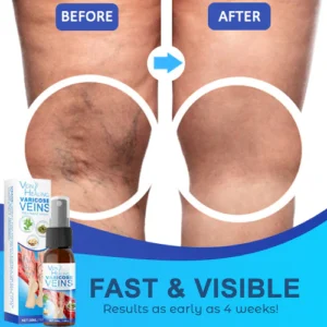 Veinhealing Varicose Veins Treatment Spray