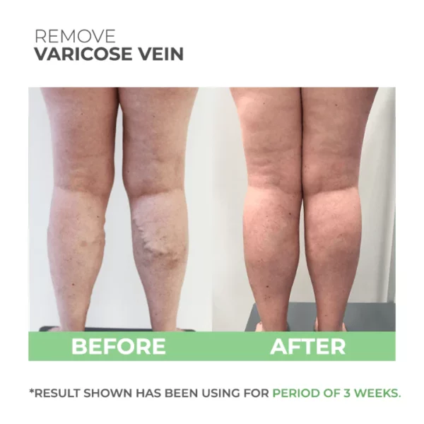 Wormwood Varicose Veins Care Soap