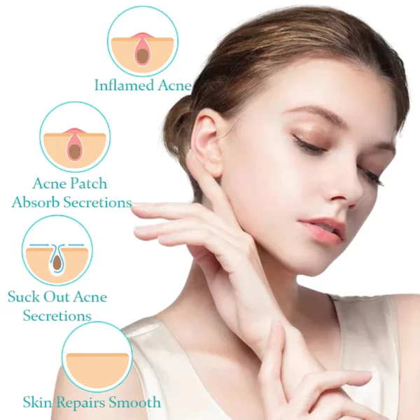 ACRēN™ Hydrocolloid Face Patches - Image 2