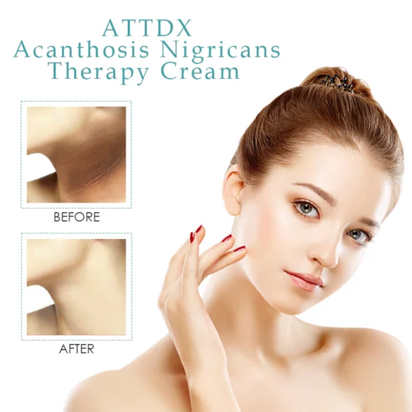 ATTDX Acanthosis NigricansTherapy Cream - Image 7