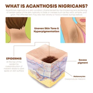 ATTDX Coffee Acanthosis Nigricans BodyScrub