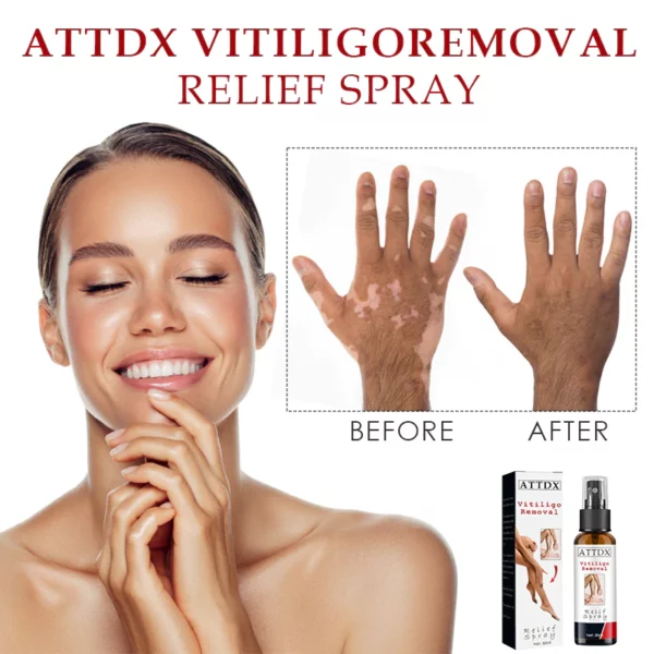 ATTDX VitiligoRemoval Relief Spray