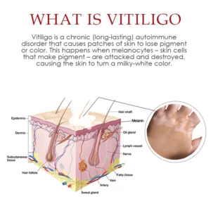 ATTDX VitiligoRemoval Relief Spray