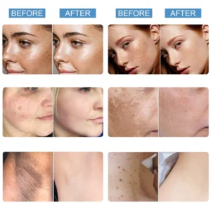 Fivfivgo™ Blemish Treatment Serum for Dark Spots & Acanthosis Nigricans & Skin Tag