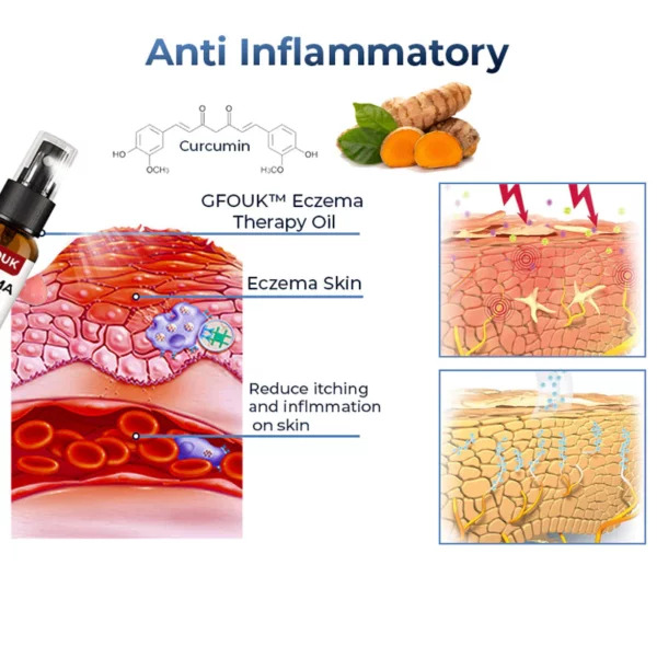 GFOUK™ Eczema Therapy Spray