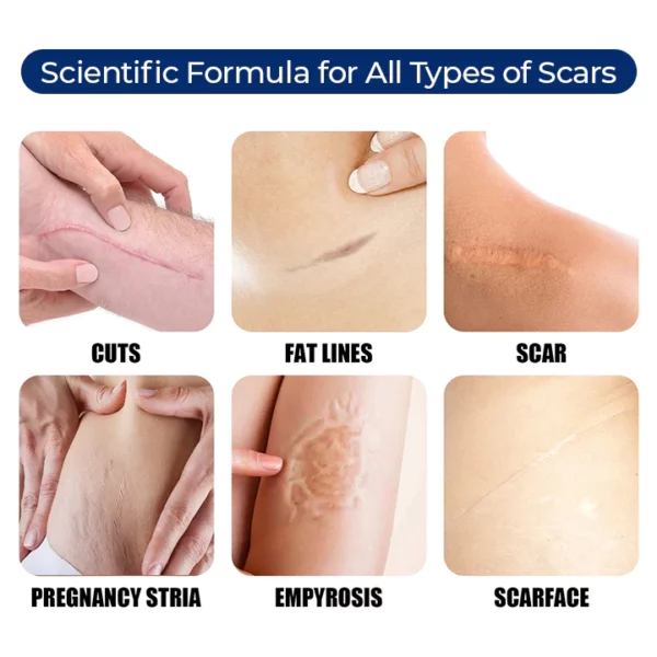 MEDix™ Advanced Silicone Scar Gel