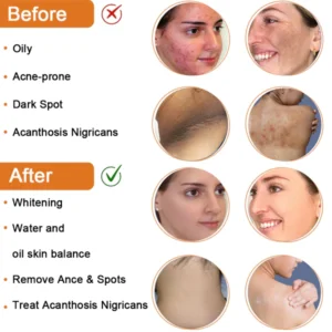 MX™ Cleansing Lotion for Acne & Spots & Acanthosis Nigricans