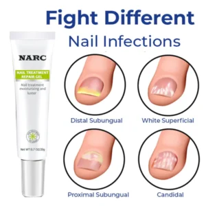 NARC™ Removal Paronychia Gel