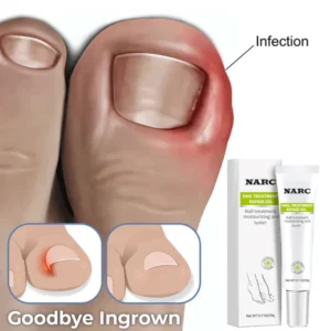 NARC™ Removal Paronychia Gel