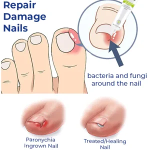 NARC™ Removal Paronychia Gel