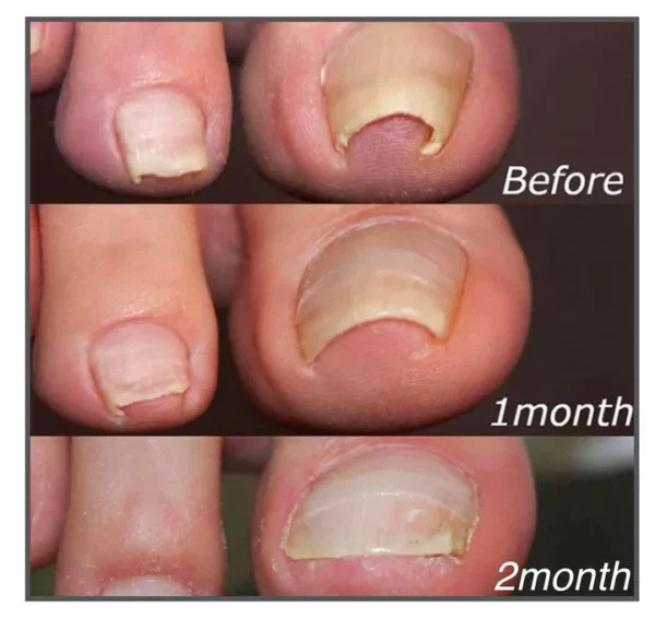 Nail Correction Patches - Image 4