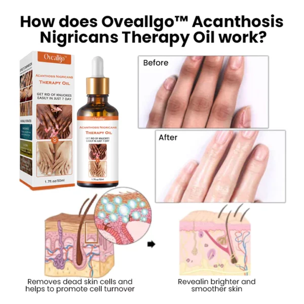 Oveallgo™ Acanthosis Nigricans Therapy Oil - Image 2