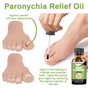 Oveallgo™ FootCure Removal Paronychia Gel