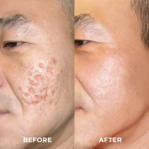 ProRegen™ Medical Scar Removal Spray