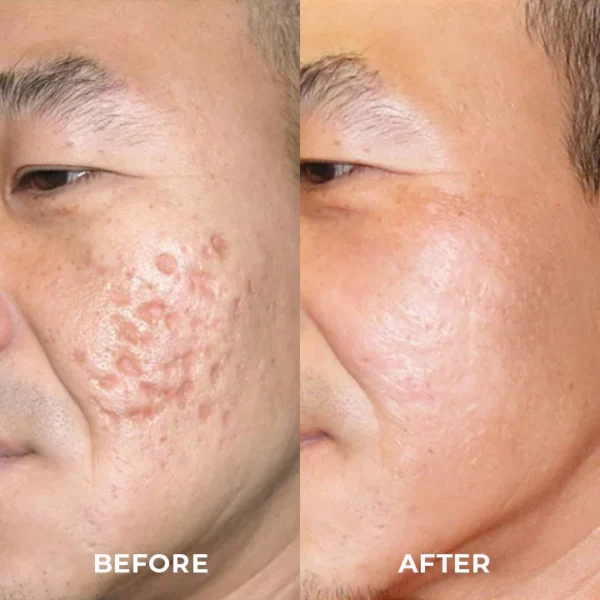 ProRegen™ Medical Scar Removal Spray