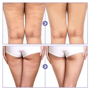 SKINNIER Tightening & Cellulite-Reducing Thigh Patch