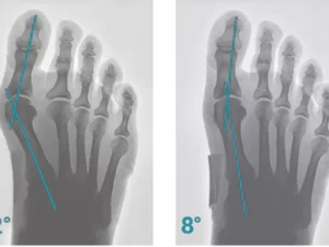 StrongJoints Adjustable Bunion Corrector