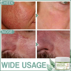 Varicose Treatment Cream