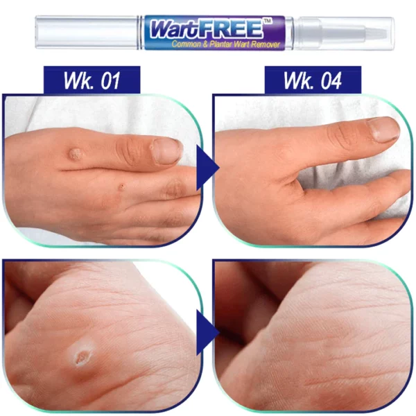 WartFREE™ Common & Plantar Wart Remover - Image 3