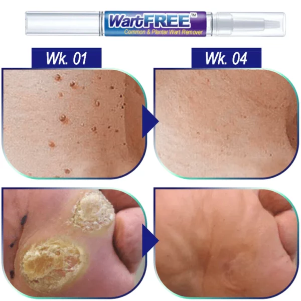 WartFREE™ Common & Plantar Wart Remover - Image 4